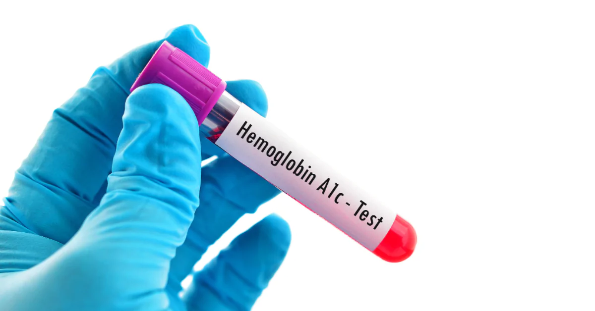 Hemoglobina Glicada 6 é normal? Este artigo explora se um nível de hemoglobina glicada de 6% é normal ou não. A análise abrange a interpretação dos resultados deste exame, o que significa para pessoas com ou sem diabetes, e recomendações para controle glicêmico eficaz.