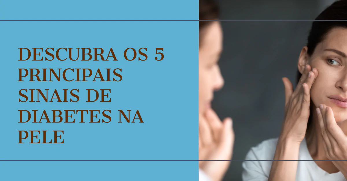 5 principais sinais de Diabetes na pele. O artigo explora os 5 principais sinais de diabetes na pele, incluindo Acanthosis Nigricans, ressecamento e coceira, infecções fúngicas e bacterianas, dermopatia diabética, e xantomas diabéticos. Destaca a importância do reconhecimento precoce desses sinais para um efetivo manejo do diabetes e a prevenção de complicações. Com dicas práticas e informações detalhadas, o texto é um recurso valioso para diabéticos e cuidadores.